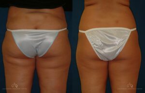 Patient 7 - Liposuction Back Before and After