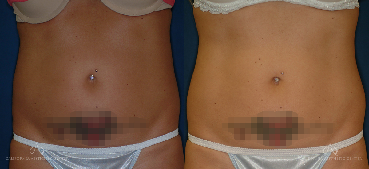 Patient 8 - Liposuction Before and After