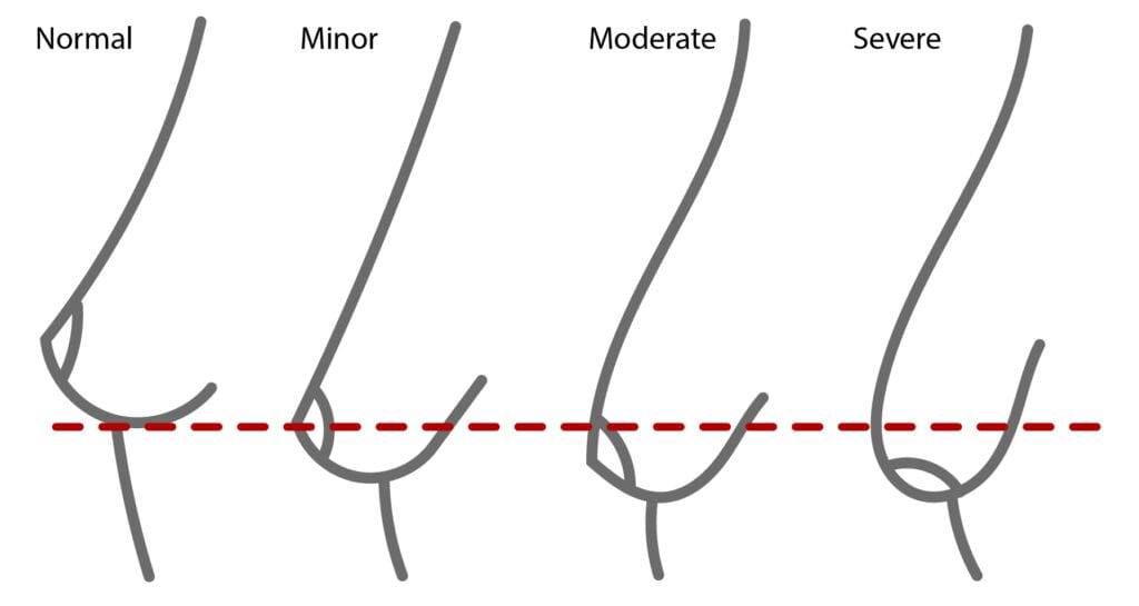 Breast Sagging Examples