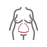 Standard Tummy Tuck