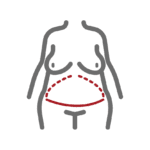 Extended Tummy Tuck